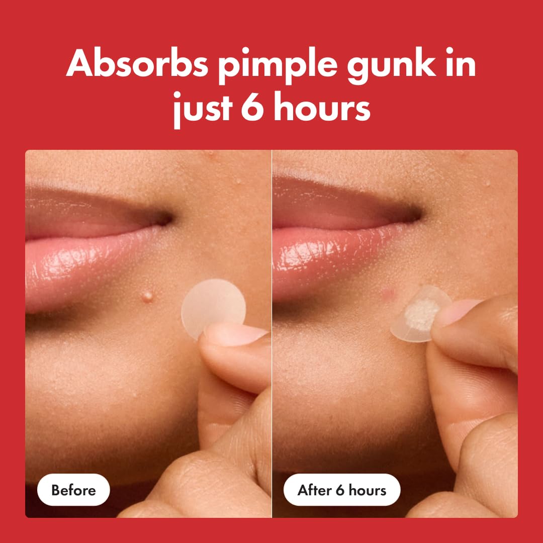 Mighty Patch Acne Patches – Fast-Acting Hydrocolloid Spot Treatment